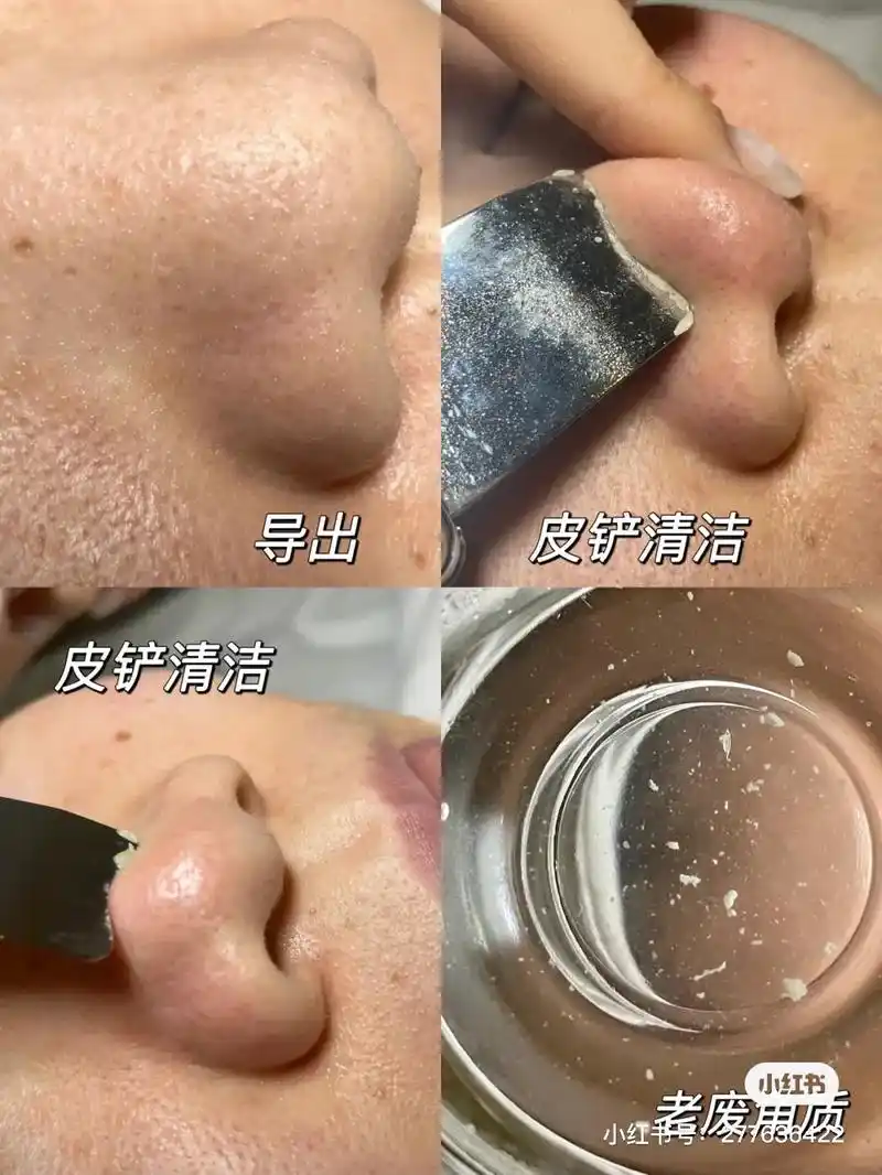面部清洁 深层清洁的作用 加快皮肤新陈代谢,祛除面部老废角质 - 抖音