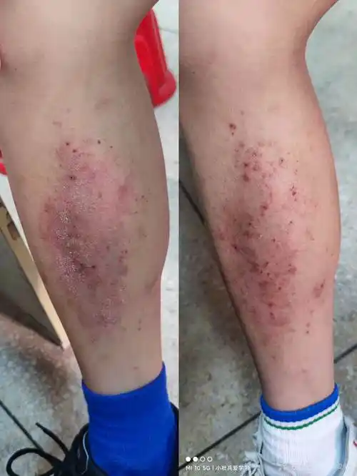 体癣or湿疹治疗一周后附治疗前后对比图