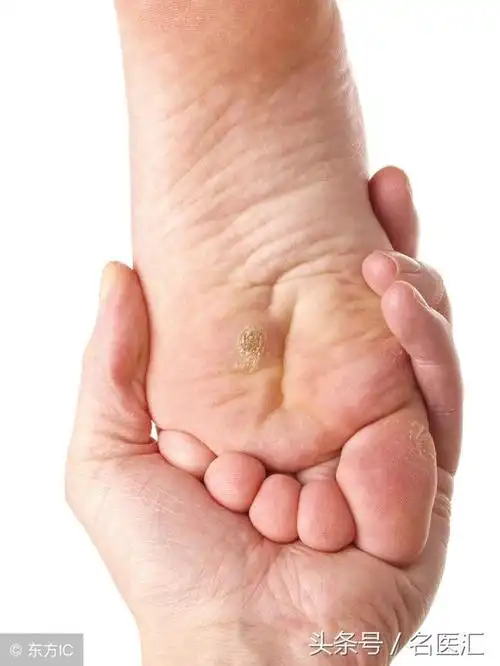 扁平疣初期图片,初期小疣体图片(扁平疣,到底是个什么玩意!