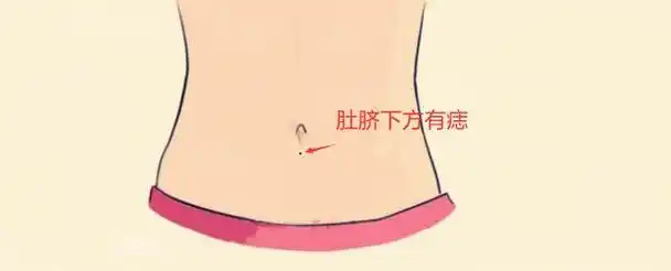 痣是身体内色素沉淀的一种生理现象,肚脐眼边上长痣并没有什么特别的