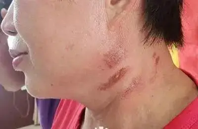 裸露位置被水母蛰肿已经开始糜烂泳衣对脖子和肩膀磨损严重上岸之后