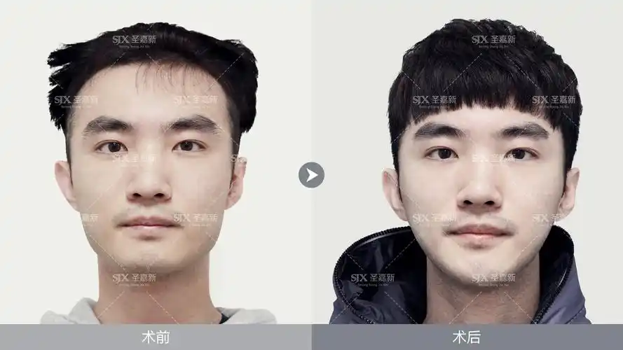 男生整容前后竟然比女生反差还大