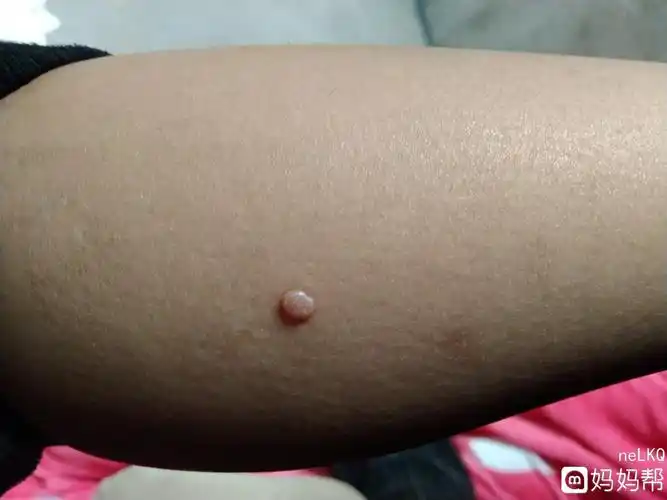 女儿小腿上长了个痘痘不知道是什么看上
