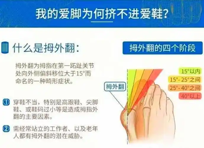 拇外翻的不同阶段_拇外翻_医疗健康_医疗健康其他