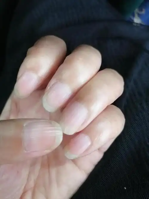 指甲竖纹明显怎么回事(指甲竖纹是怎么回事)(2)