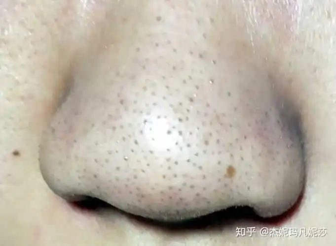 油性皮肤鼻子上有黑头毛孔粗大怎么办?