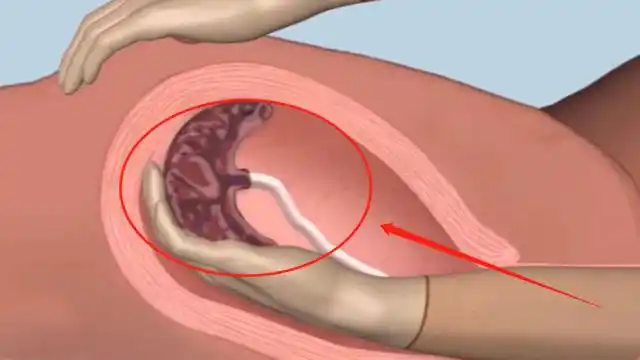手剥胎盘到底有多痛3d展示全过程看完后忍不住泪目