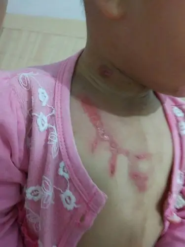 一岁宝宝开水烫伤怎样不留伤疤?