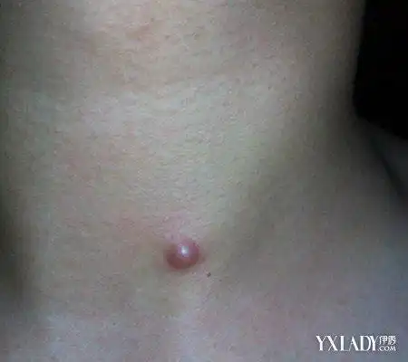 【图】脖子上长小肉粒图片 专家告诉你怎么治疗才能去掉