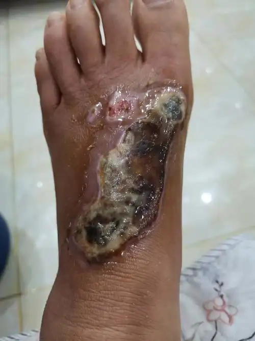 传统中医药治疗皮肤坏死一例