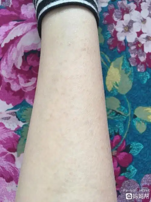 为什么腿上老长老年斑呢 为什么腿上老长老年斑呢图片