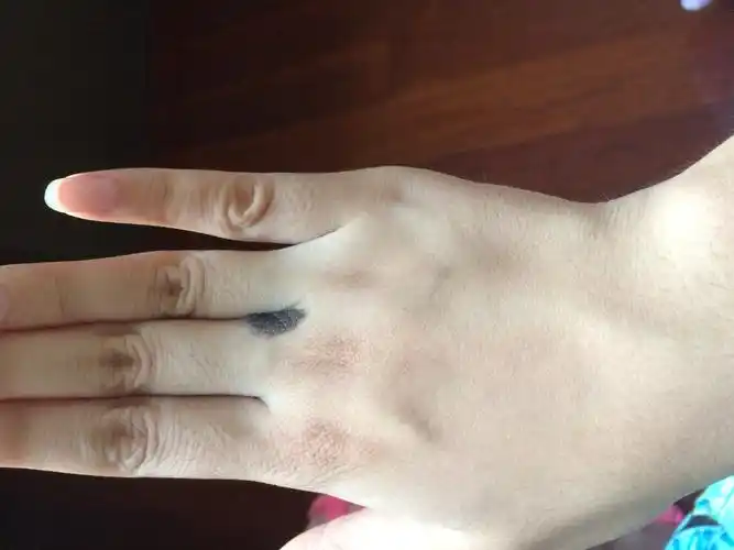 我右手中指无名指的指缝根部有一颗先天痣小时候挺小的我长