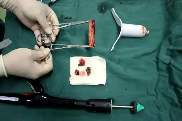 痔疮患者的福音我院外科成功开展tst痔疮微创手术