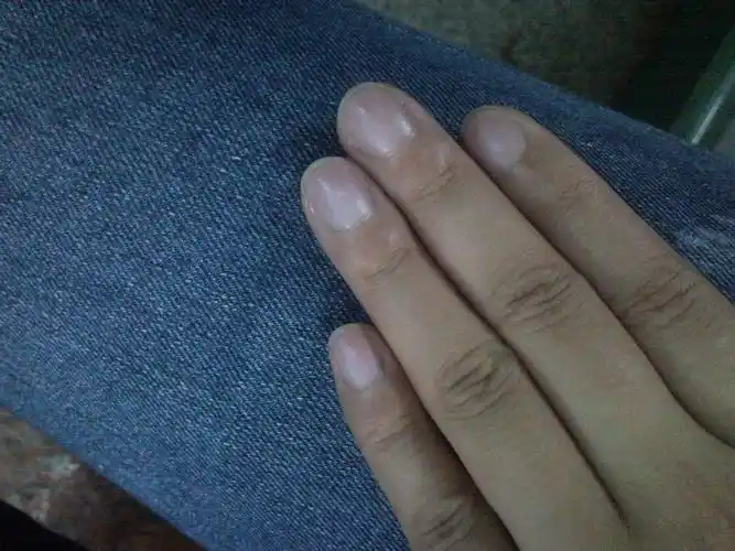 我的指甲为什么是发紫的,好像有几年了,不过身体很健康