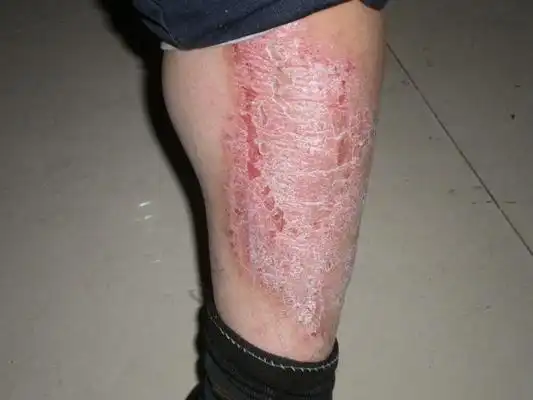 牛皮癣的初期图片7