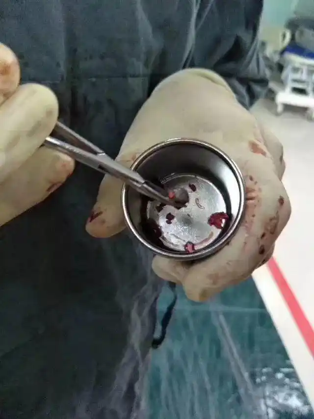 谁干的?5岁女孩小区内头部"中弹"险丧命!事发时对面楼内传出"枪声"