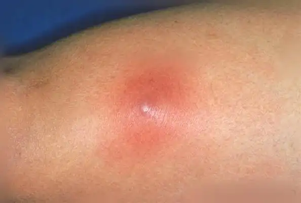 火疖子各时期图片45