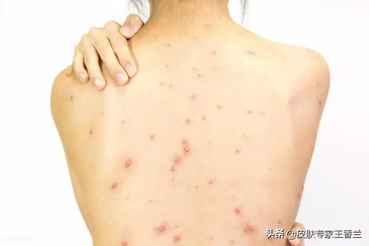 夏季来袭,背后长痘当心是细菌感染