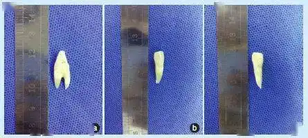【病例分享】右侧下颌尖牙双根双根管一例_治疗_患者_牙根