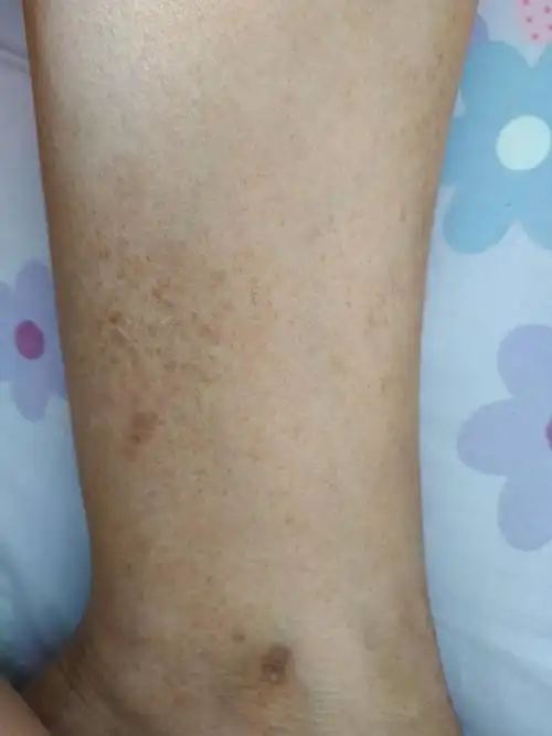 糖尿病腿是这样的怎么回事能不能治疗