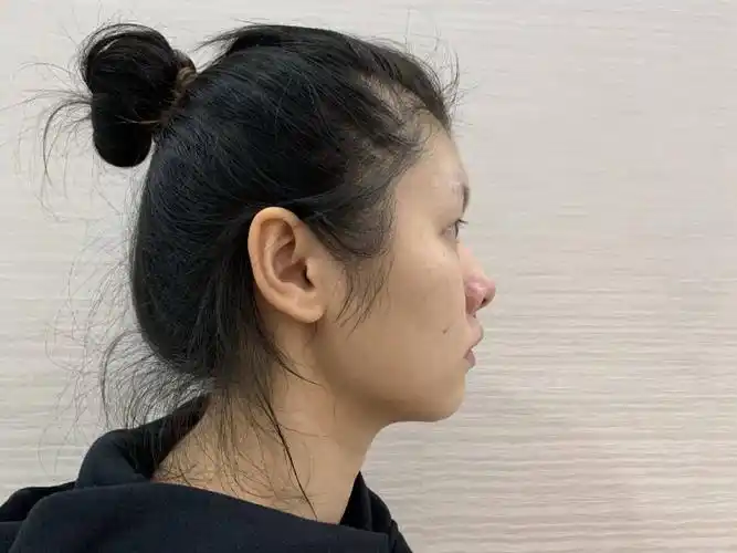 问题天生单眼皮鼻梁低正面露鼻孔