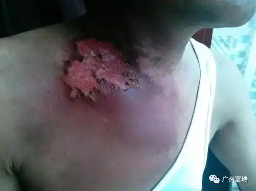 皮肤溃烂2.jpg