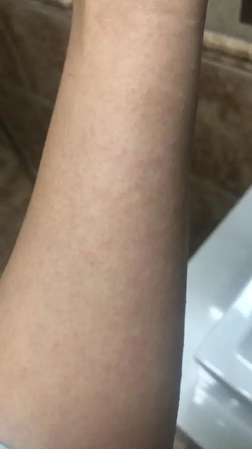 疹子是消了但是又剩下好多小红点这是咋回事啊