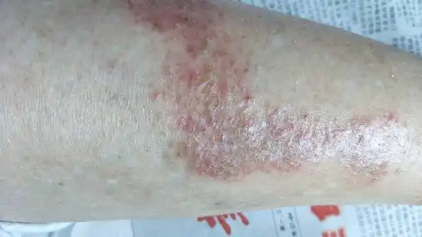 请问是什么皮肤病,老年人腿上起红疹,很痒怎么治