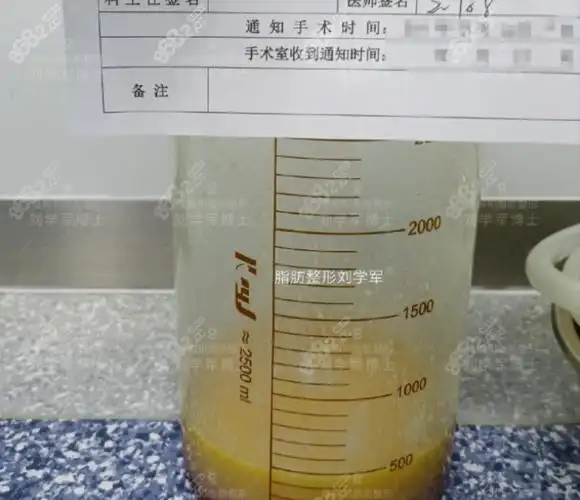 刘学军医生做吸脂手术抽出来的脂肪
