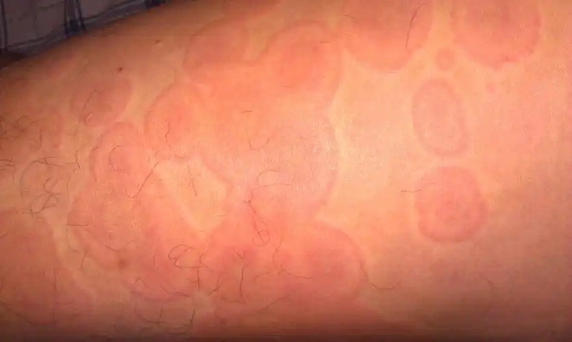 慢性荨麻疹怎么治疗 - 皮肤及性传播疾病讨论版 - 爱爱医医学论坛