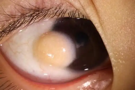 女童右眼长瘤医院仅用一天找到角膜供体进行手术