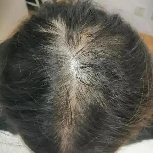 头发秃了吃黑芝麻黑芝麻掉头发