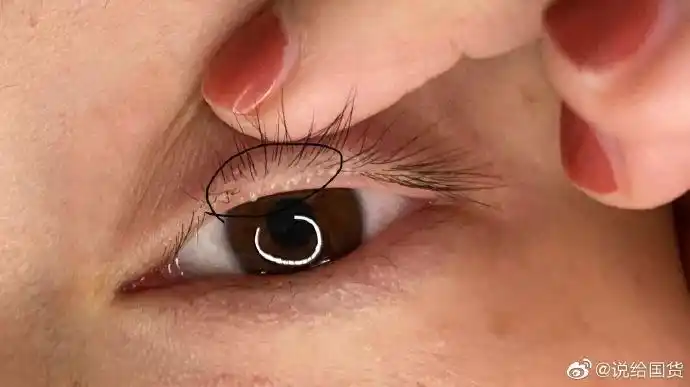 投稿,请问有姐妹会突然上眼睑长小颗粒. 来自说给国货 - 微博