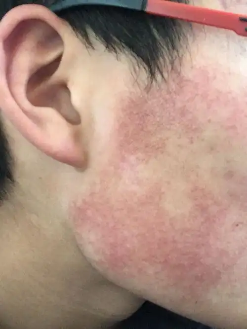 我是有皮肤病吗? 脸上有一层小的疙瘩 红红的 不痛也不痒 有好几年了