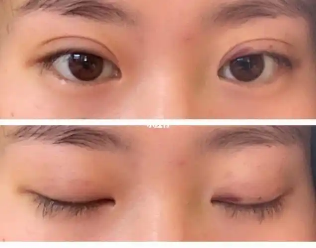 埋线双眼皮610天