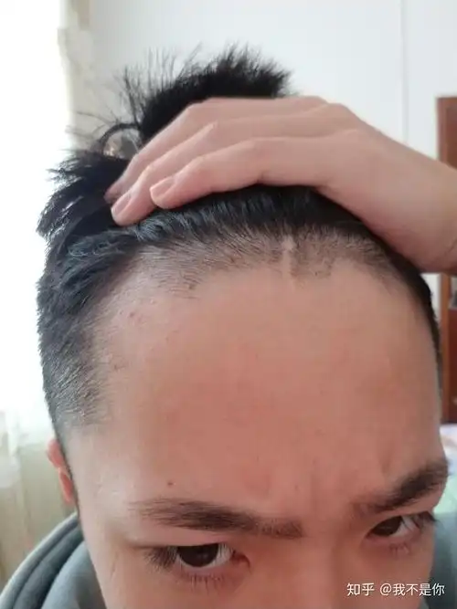我这头发发际线是不是很高