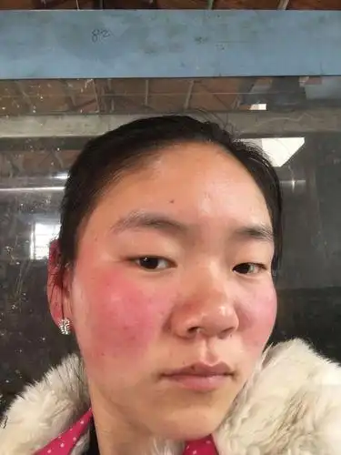 稍微热一点脸就很红怎么办脸遇热发红咋办