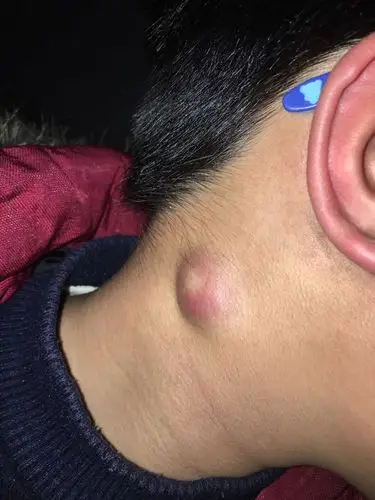 之前右脖子长了一年多的黄豆大小的硬包,不痛不痒,最近突然肿的很大