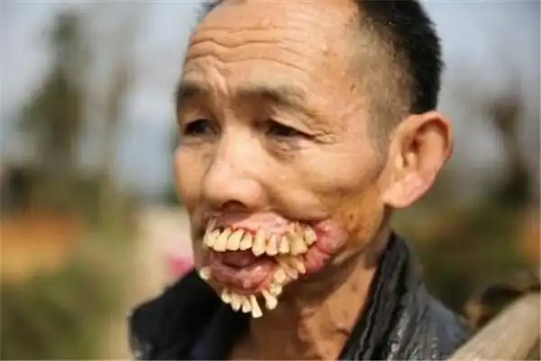 世界上牙齿最多的人来自印度的小男孩拥有526颗牙