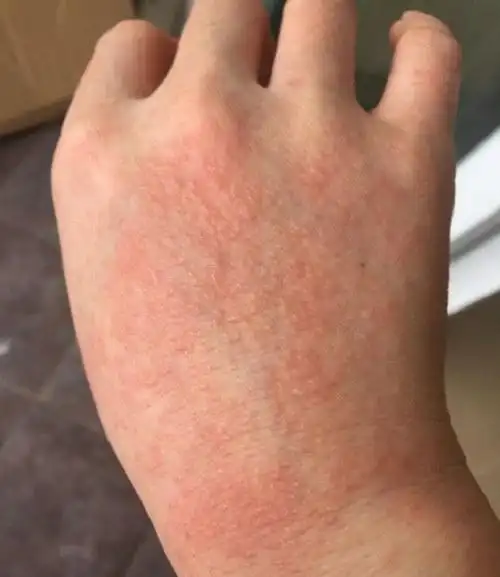 时发现双手背起了不同程度的红色皮疹,又痒又痛,咨询了皮肤科的罗主任