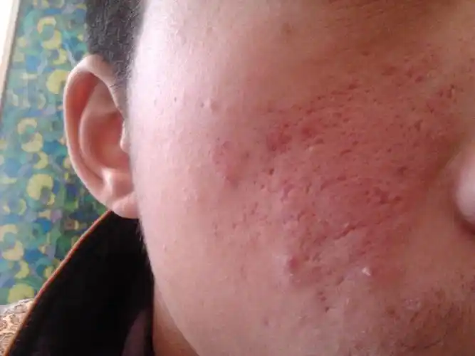 请问各位这是什么类型的痘印啊 还是毛孔的问题啊 我