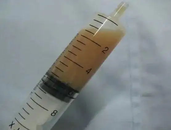 乳糜性胸水咋确定