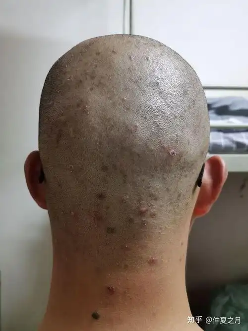 头皮毛囊炎怎么办头皮长了很多痘痘怎么治