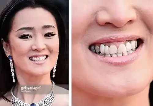 女神巩俐,也没有逃过换牙的诱惑,之前健康正常的大牙,处理之后牙龈
