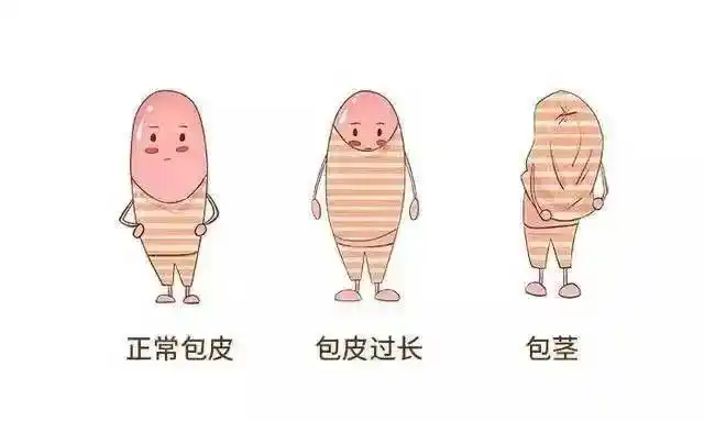 割包皮要趁热暑期包皮手术黄金期早安排更省心