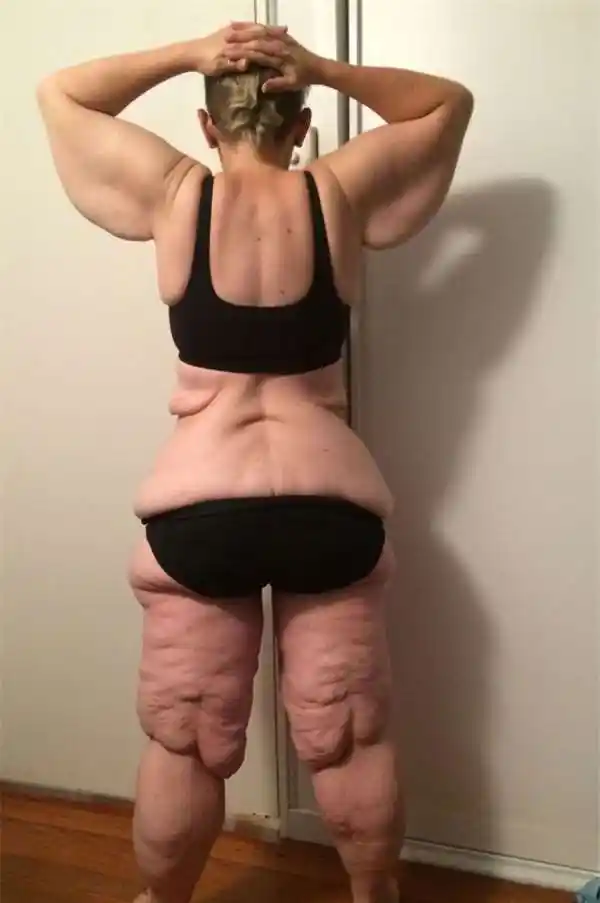 可是这样快速的减肥却使得她的皮肤严重松弛,让她心里痛苦不已,而且