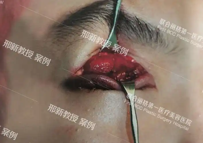 上睑提肌腱膜推进法上脸下垂矫正术及案例