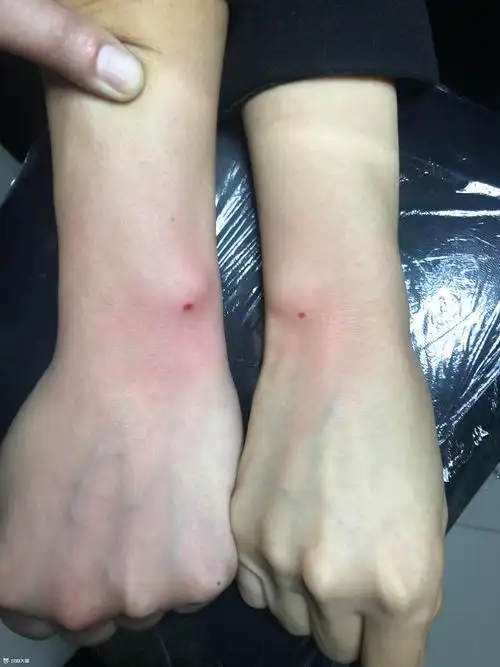 手腕朱砂痣