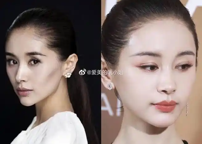 脂肪填充##颧骨##法令纹##泪沟