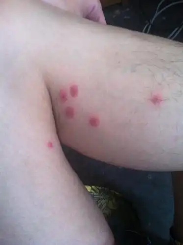 这些包包是跳蚤咬的吗?